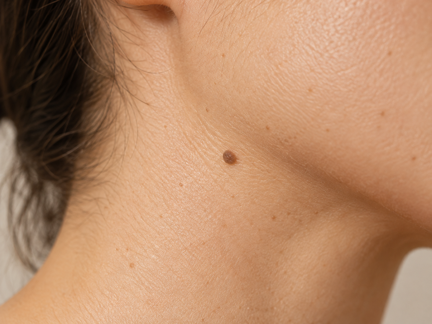 Excess facial hair and PCOS hair growth